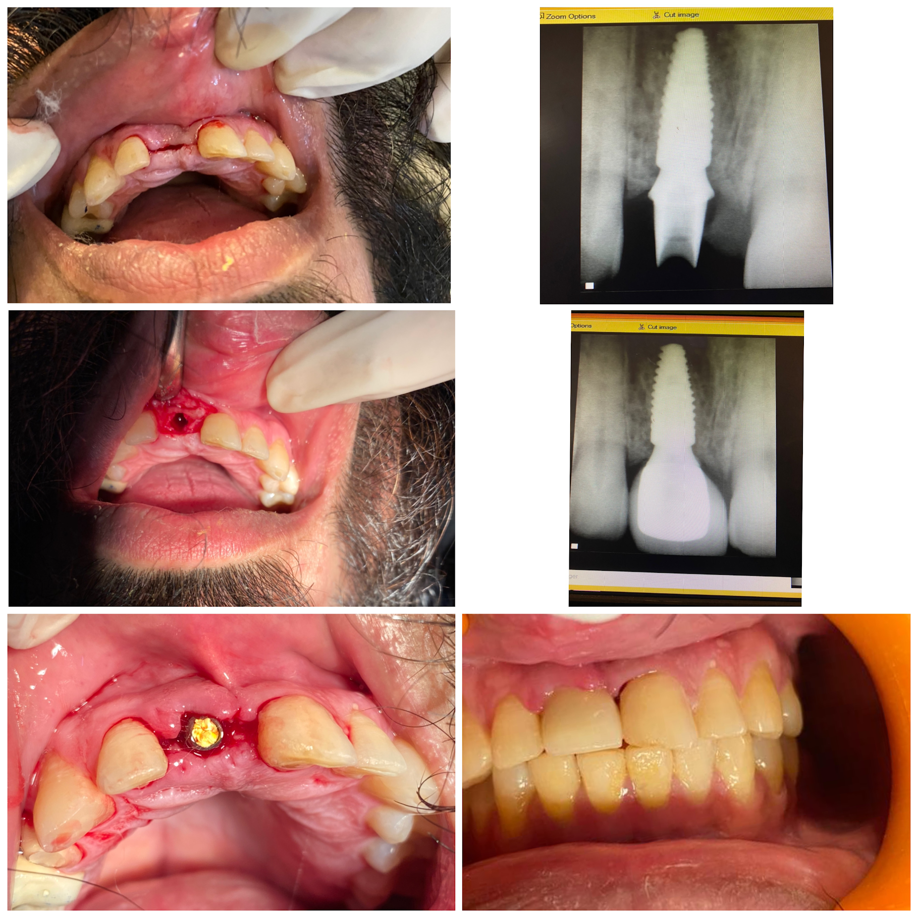 Real anterior dental implant case at Poly Dental Clinic Mohali, extraction, implant placement, healing, and final restoration with X-rays