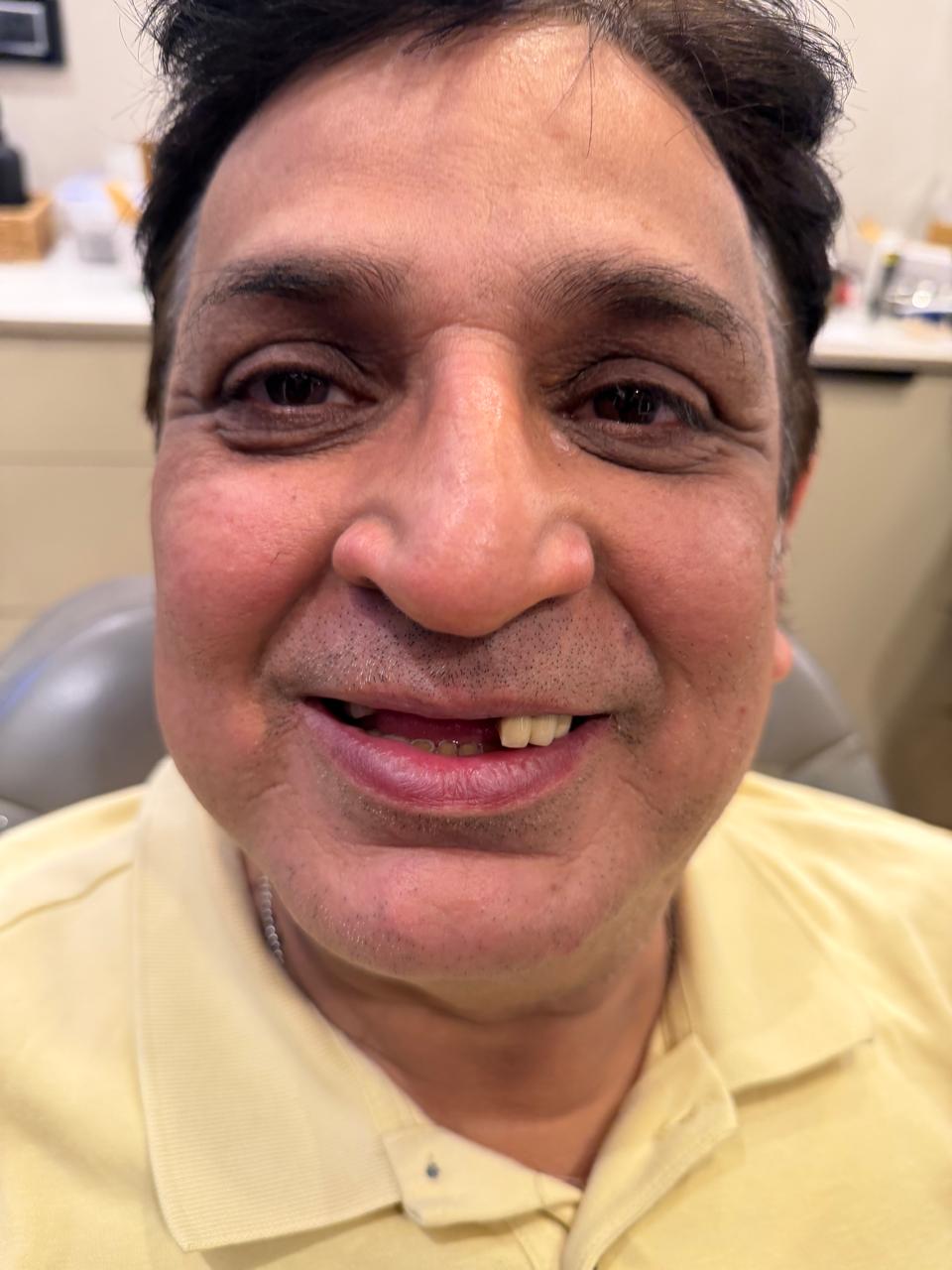 All-on-6 dental implant treatment room at Poly Dental Mohali