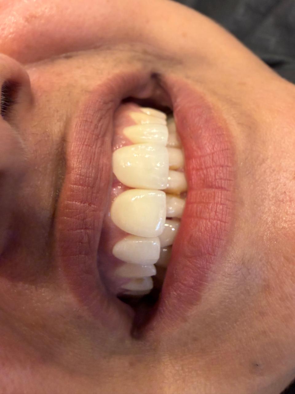 Close-up of polished teeth after scaling, smoother surface and refreshed natural shade