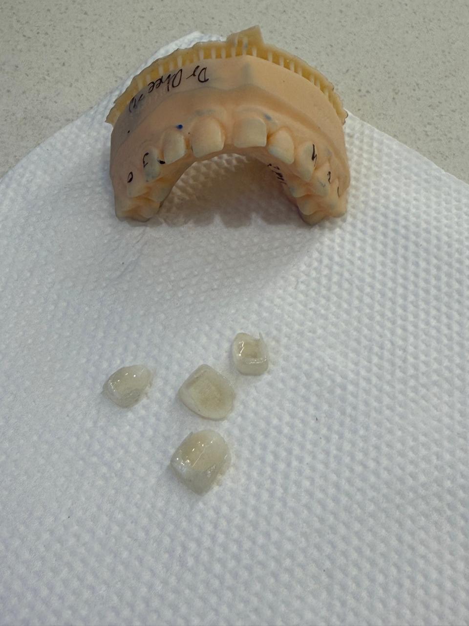 Custom-fitted dental crown and bridge restoration at Poly Dental Clinic Mohali