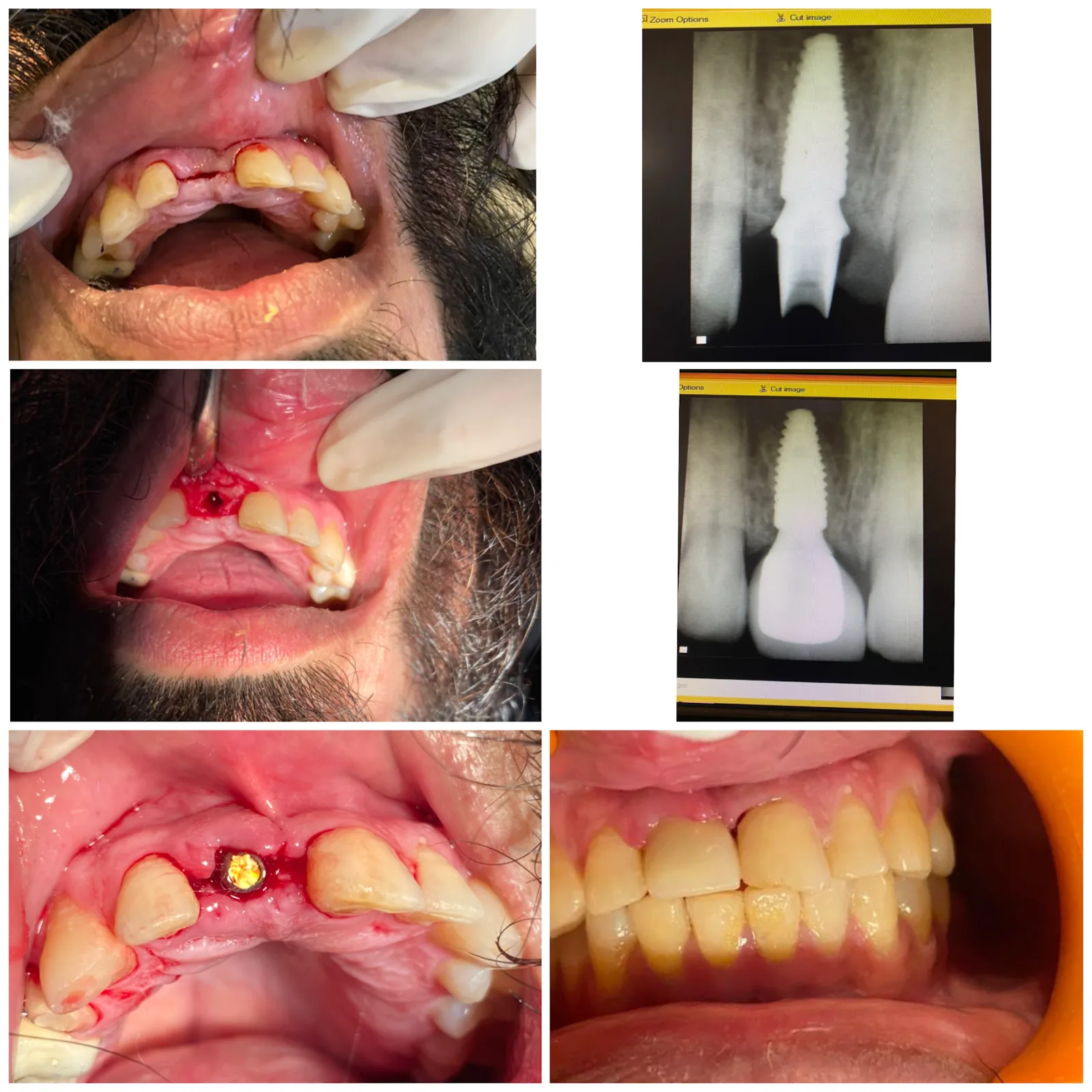 Real anterior dental implant case at Poly Dental Clinic Mohali, extraction, implant placement, healing, and final restoration with X-rays