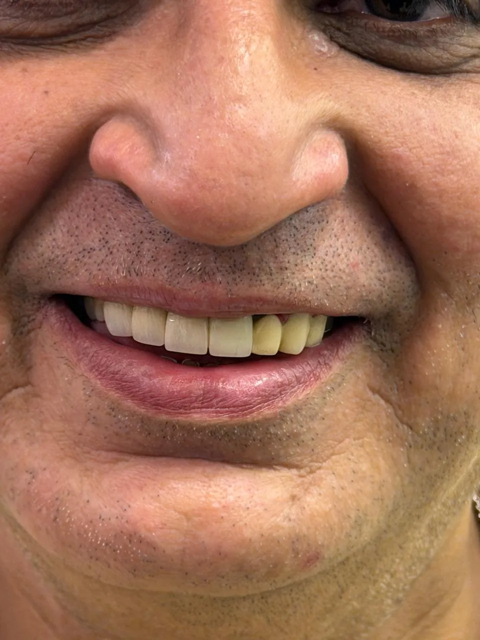 Implant-supported bridge replacing multiple teeth at Poly Dental Mohali