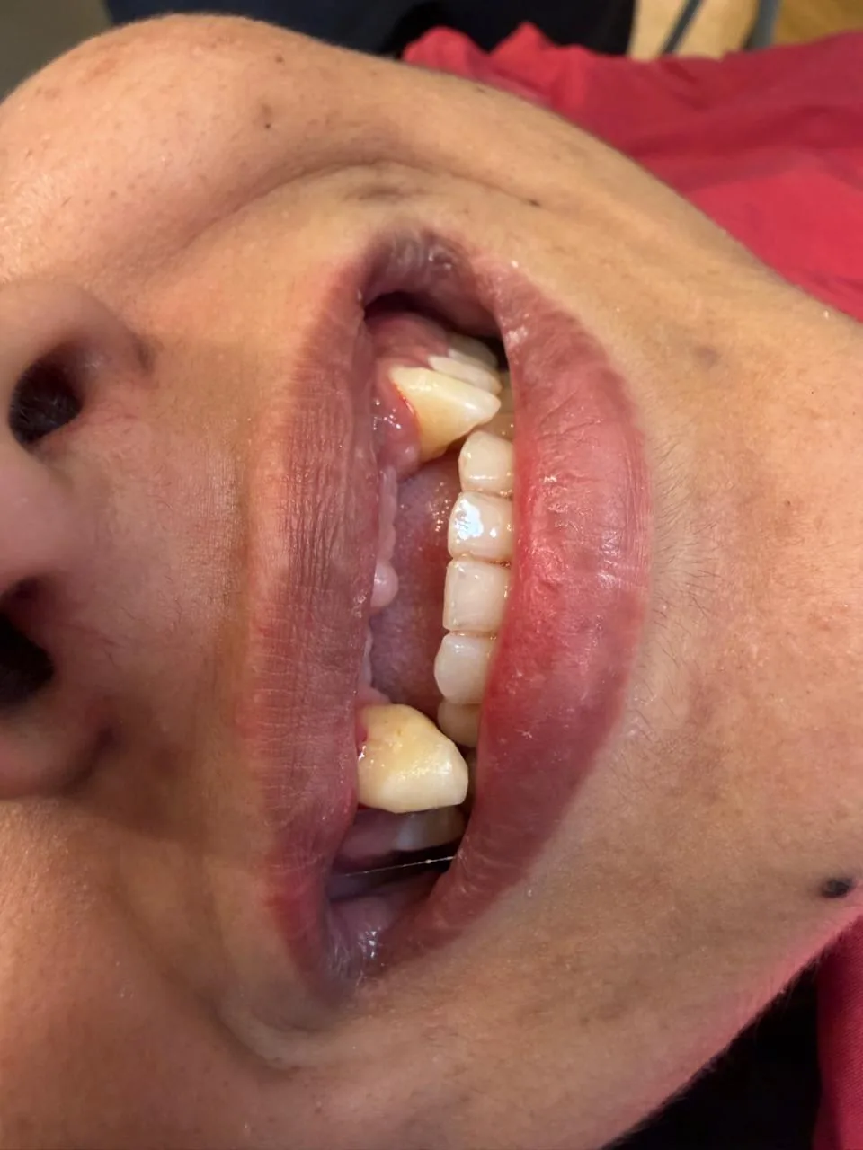 Single tooth dental implant supporting one ceramic crown