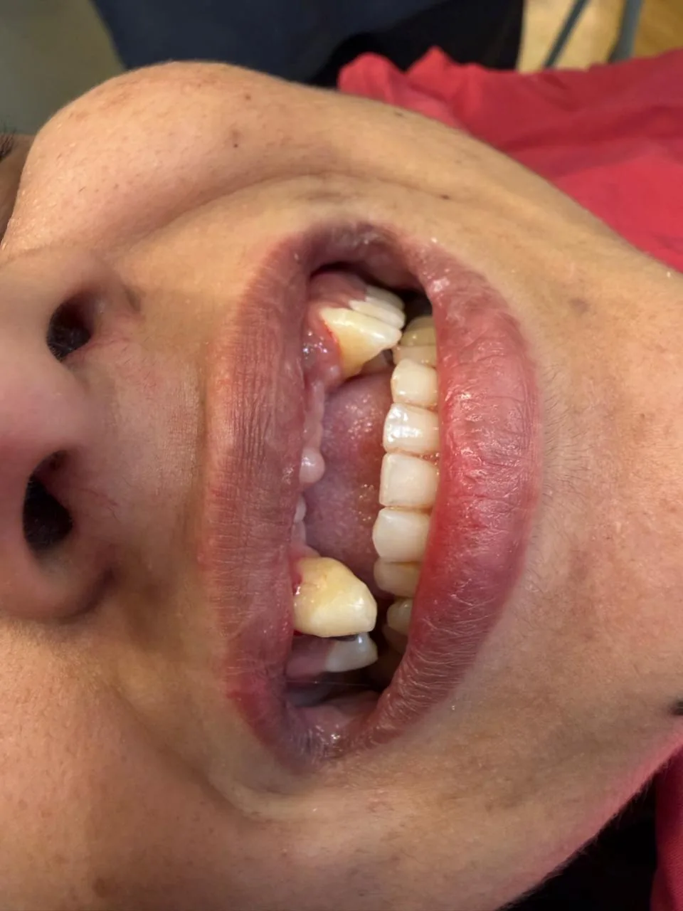 Mini dental implant consultation at Poly Dental Mohali