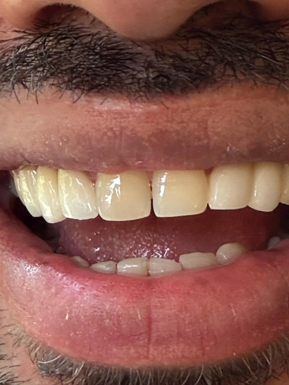 Full-arch custom ceramic crowns after treatment, even shade and natural shape