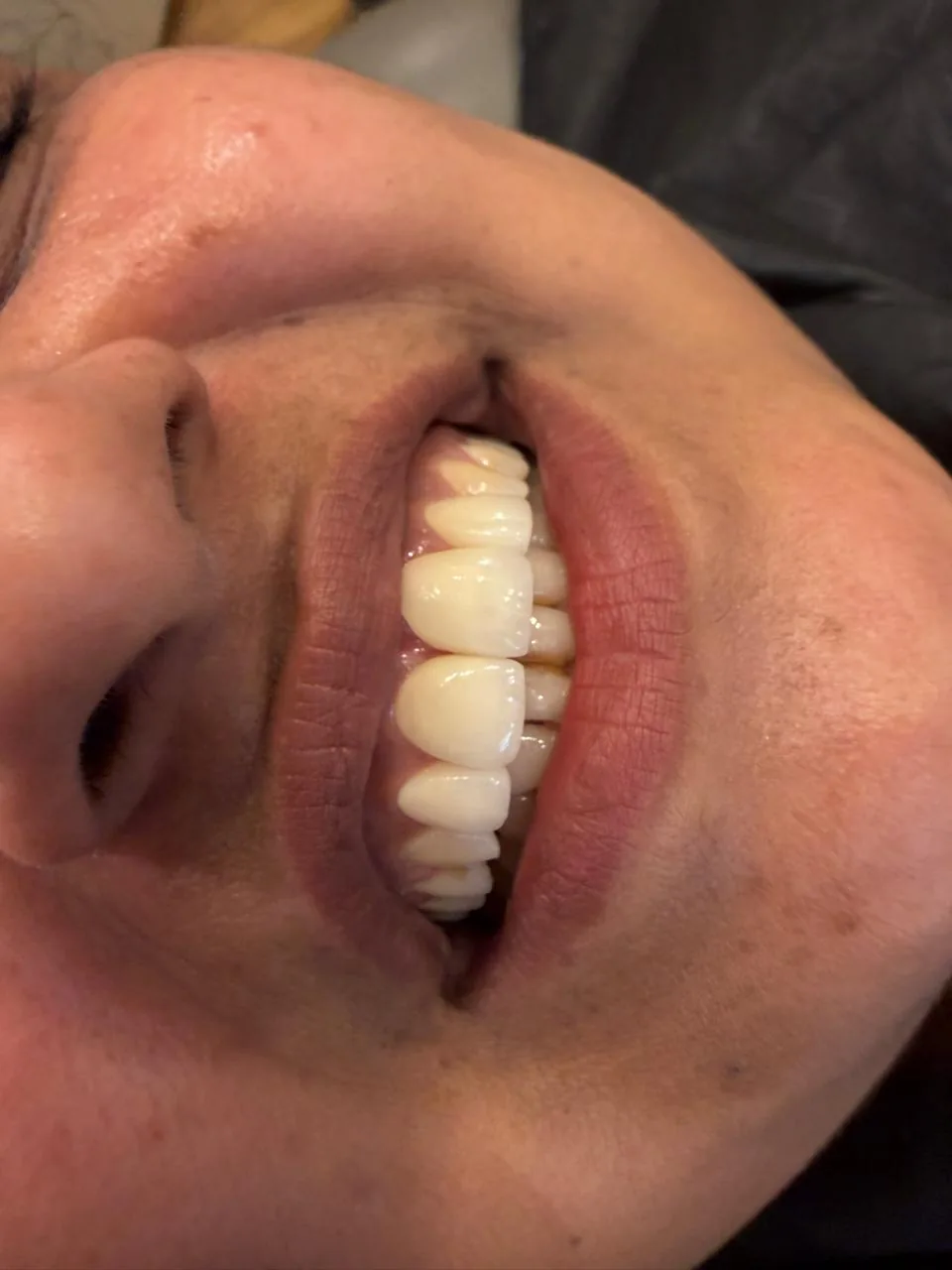 Teeth after scaling and polishing, clean and stain-free