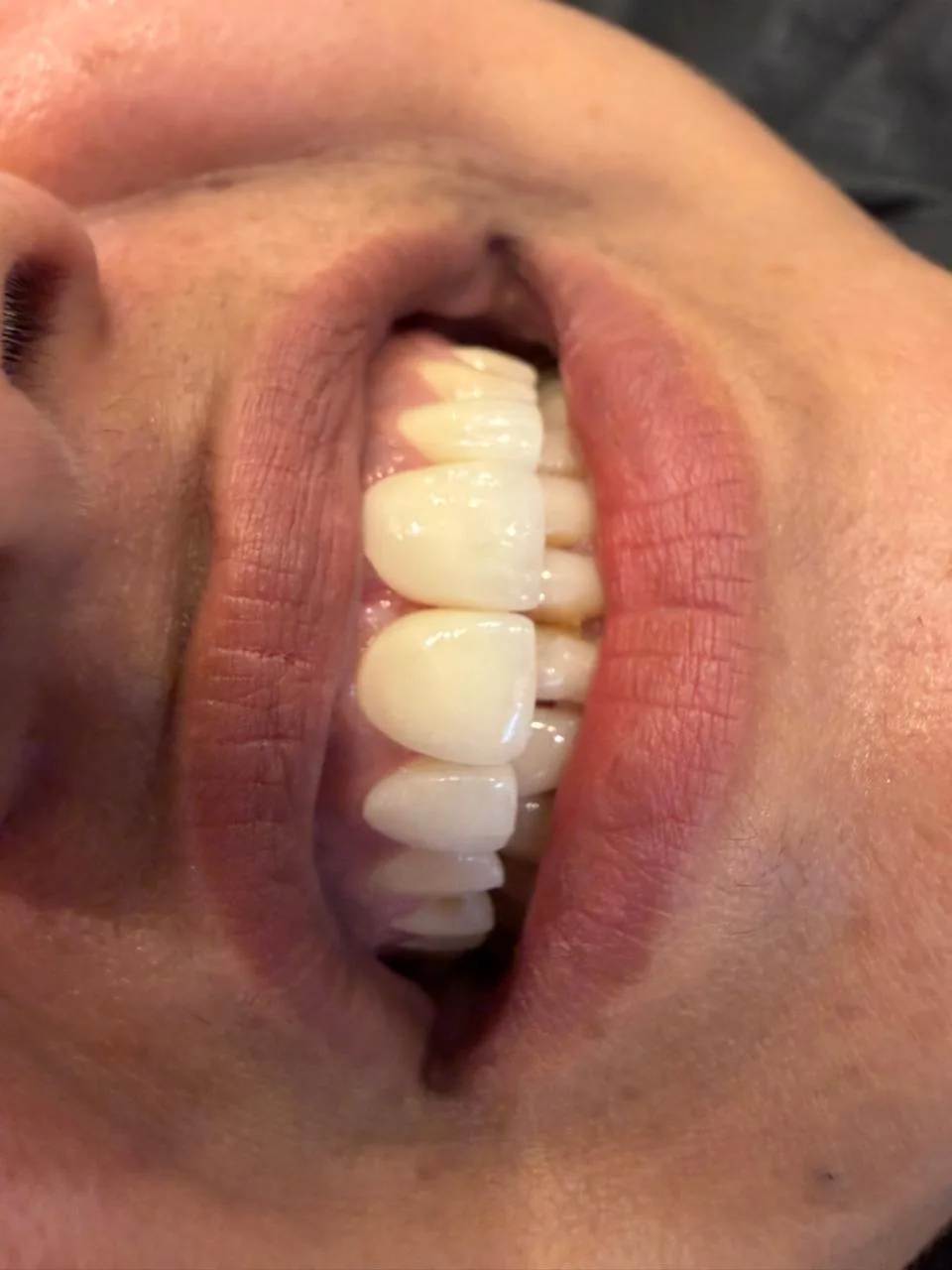 Close-up of polished teeth after scaling, smoother surface and refreshed natural shade