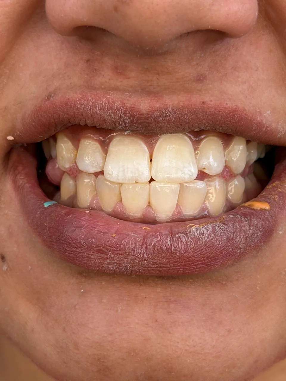 Teeth before scaling and cleaning, visible tartar and staining