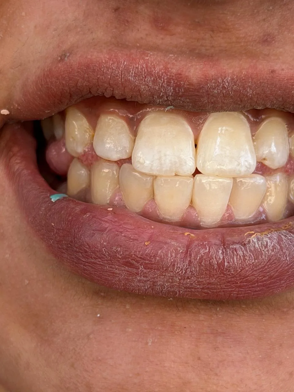 Professional teeth scaling and cleaning at Poly Dental Clinic Mohali