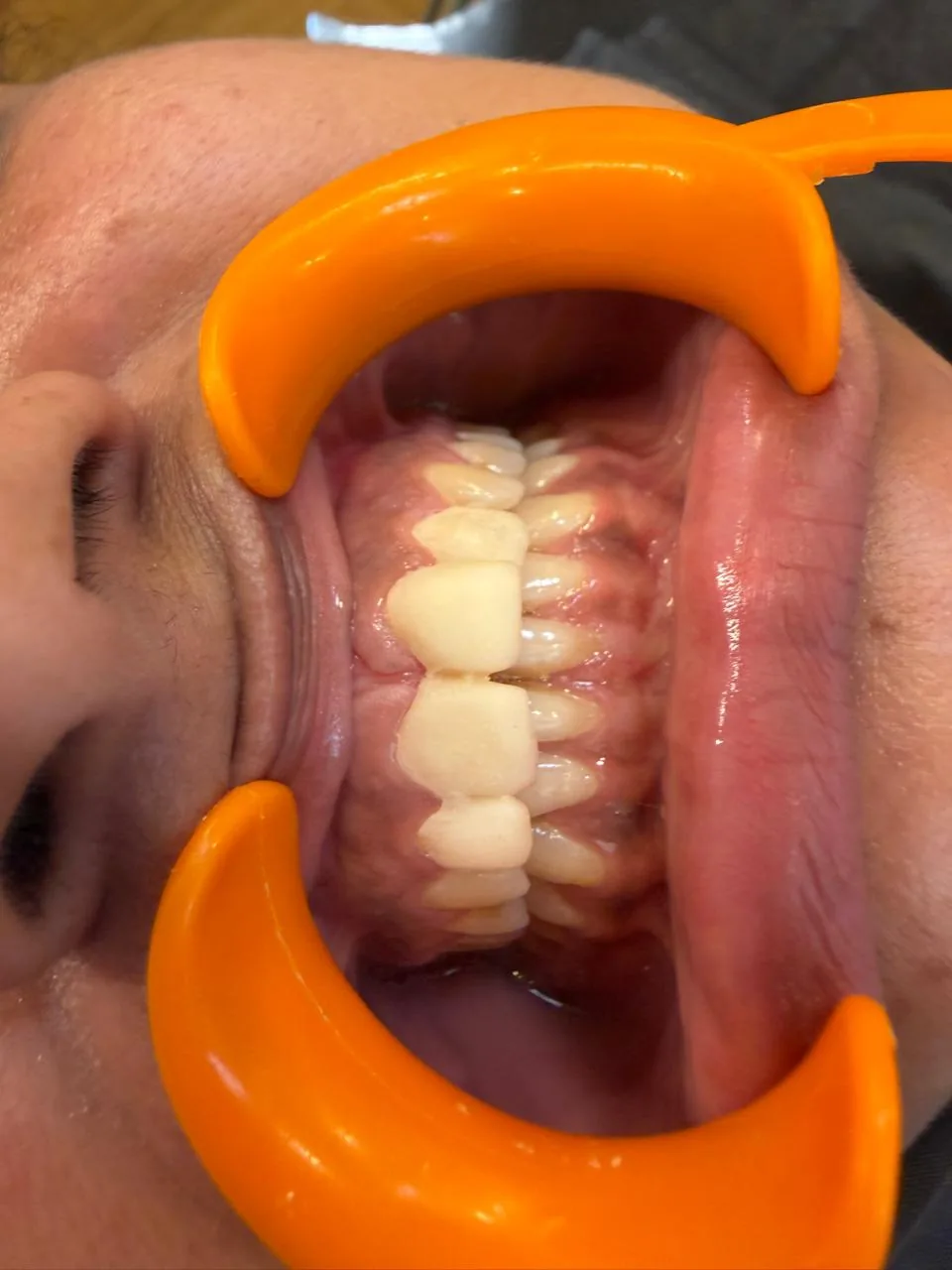 Same patient after porcelain veneers with an even, natural-looking smile