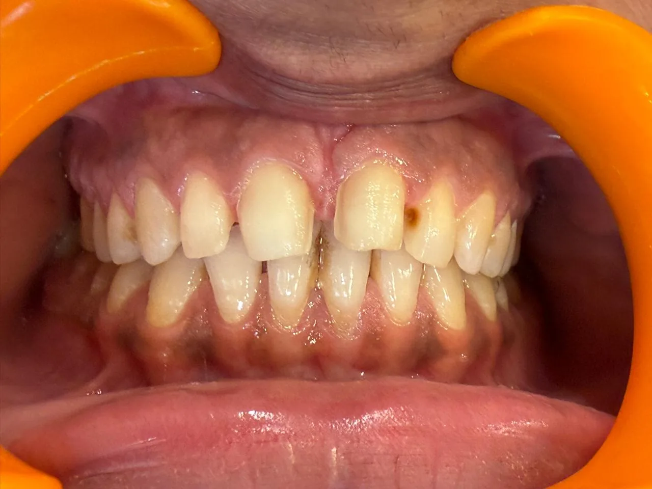 Patient teeth before porcelain veneers, visible staining and uneven shape
