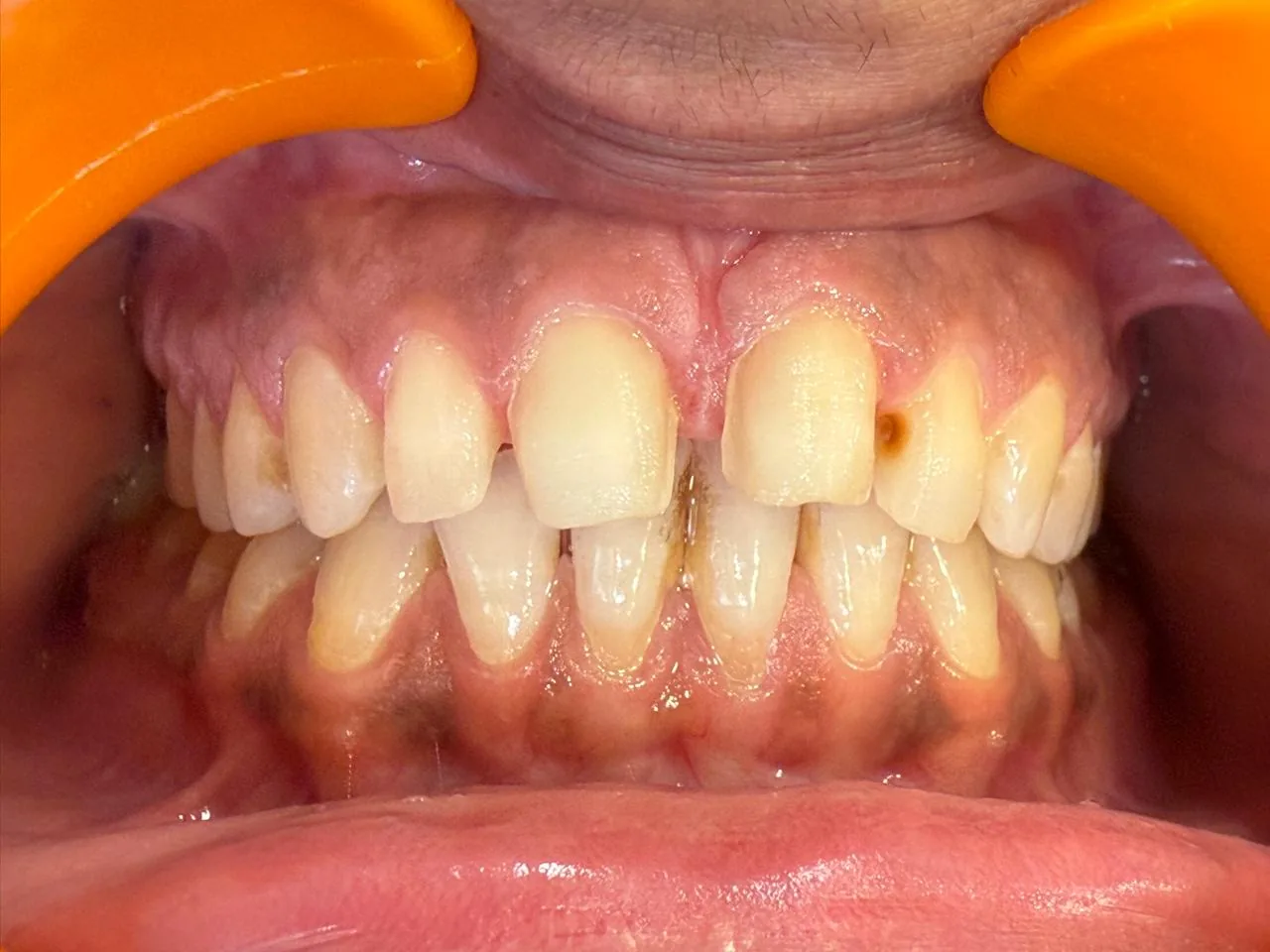 Intraoral close-up before ceramic restoration at Poly Dental Clinic Mohali