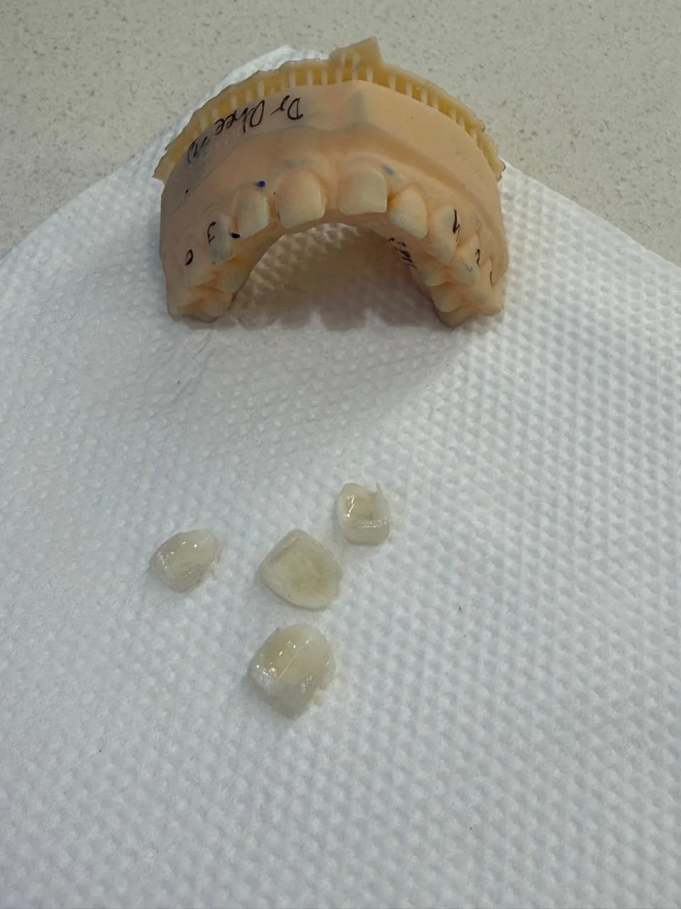 Custom-fitted dental crown and bridge restoration at Poly Dental Clinic Mohali